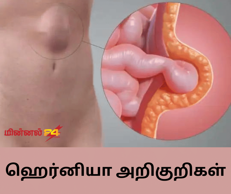 ஹெர்னியா அறிகுறிகள்