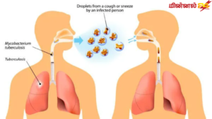 உலகளாவிய காச நோய் தினம் (World Tuberculosis Day)